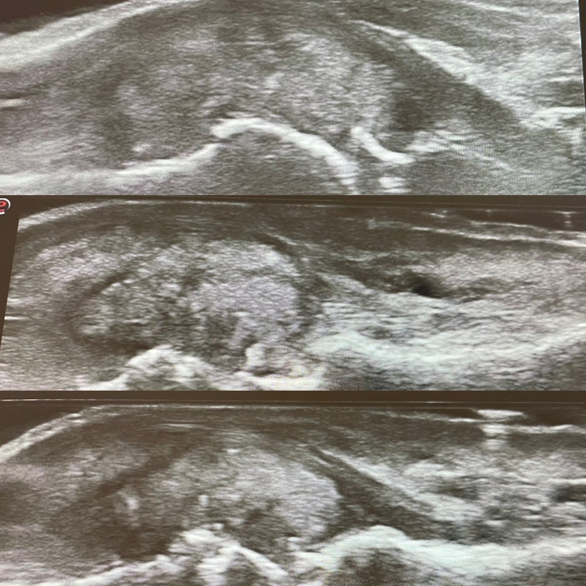 Tofo voluminoso en 1a metatarsofalángica de paciente con gota 
#gota #gout #urico #uricacid #tophus #ultrasound #rheumatology 
<a href="/drrheumatocito1/">Dr. Mendoza Torres</a> <a href="/pompermarioMD/">Mario Pompermayer MD, RhMSUS</a> <a href="/drmariochavez/">Mario Chávez</a> <a href="/Carlosguillenas/">Carlos Guillén</a> <a href="/JCNietoGon/">Juan Carlos Nieto</a> @UltrasoundRheum <a href="/ecoserser/">ECOSER</a> <a href="/ReumaEco/">Ecografía en Reumatología</a> <a href="/BorisBlancoC/">Boris Blanco C</a> <a href="/basiliu/">Basilio Rodríguez, MD, PhD</a> <a href="/cesardiaztorne/">Cesar</a>