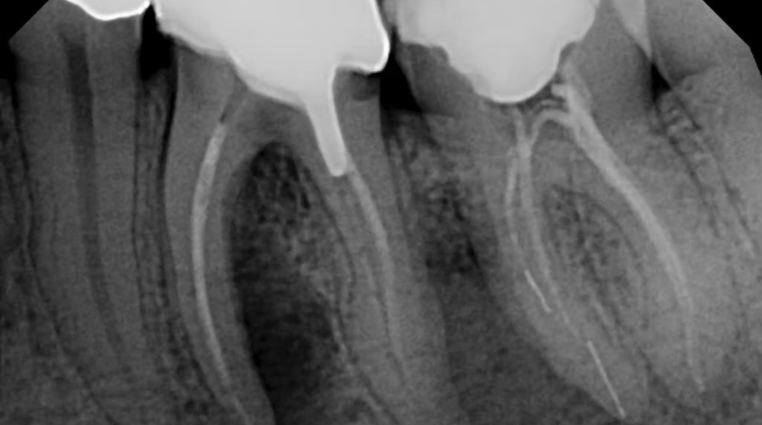 Perio-Implant Advisory is out! Can #teeth with perio-endo #infections be saved? Why doesn't the #dental crown fit? bit.ly/3vWF8An #dentistry #PerioImplantAdvisory