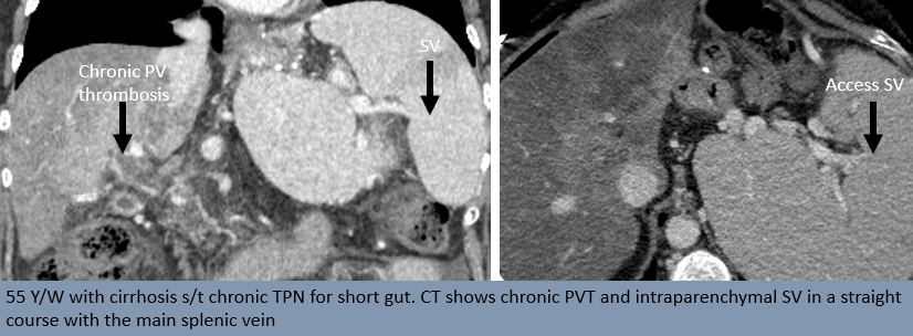 rakeshkvarma's tweet image. Clinical Pearls in IR 5:
Transsplenic access: Access intraparenchymal SV more in a straight line/direct anatomic continuity with portal system, with aid of prior axial imaging &amp;amp; US guidance
PVR for #Liver #Transplant  candidacy @uab_ir @SIRspecialists @SIRRFS @SIR_ECS @ISVIRIndia