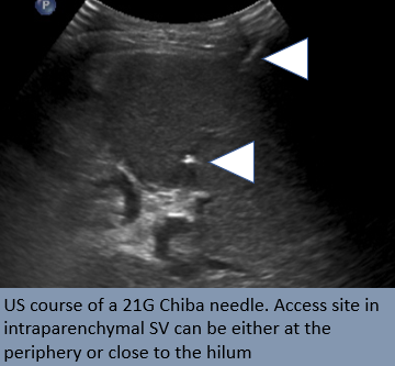 rakeshkvarma's tweet image. Clinical Pearls in IR 5:
Transsplenic access: Access intraparenchymal SV more in a straight line/direct anatomic continuity with portal system, with aid of prior axial imaging &amp;amp; US guidance
PVR for #Liver #Transplant  candidacy @uab_ir @SIRspecialists @SIRRFS @SIR_ECS @ISVIRIndia
