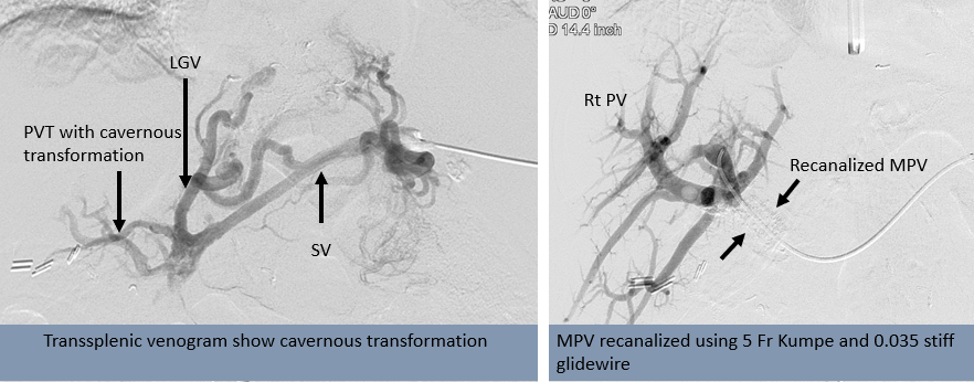 rakeshkvarma's tweet image. Clinical Pearls in IR 5:
Transsplenic access: Access intraparenchymal SV more in a straight line/direct anatomic continuity with portal system, with aid of prior axial imaging &amp;amp; US guidance
PVR for #Liver #Transplant  candidacy @uab_ir @SIRspecialists @SIRRFS @SIR_ECS @ISVIRIndia