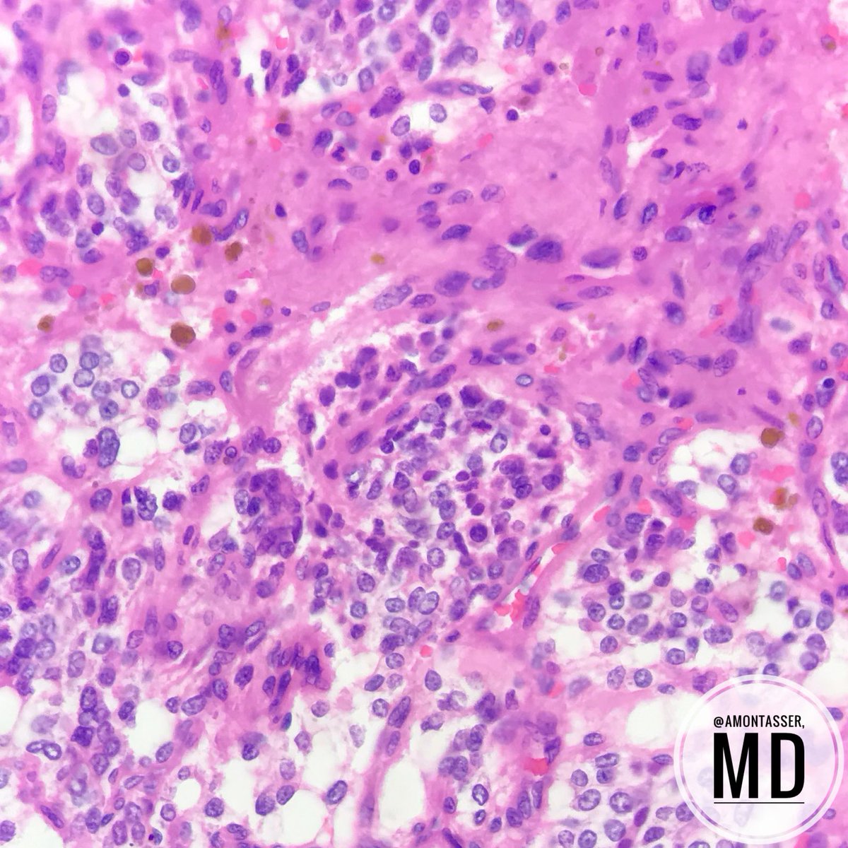 AMontasserMD's tweet photo. When tumors read books:
• At carotid body
• “zellballen” nested arrangement with prominent fibrovascular stroma
• Nuclear atypia but rare mitosis
• Melanin-like pigment 

#Endocrine #Pathology #BenignIsBeautiful #Pathresident #PathClassic https://t.co/kKaX0gZCku