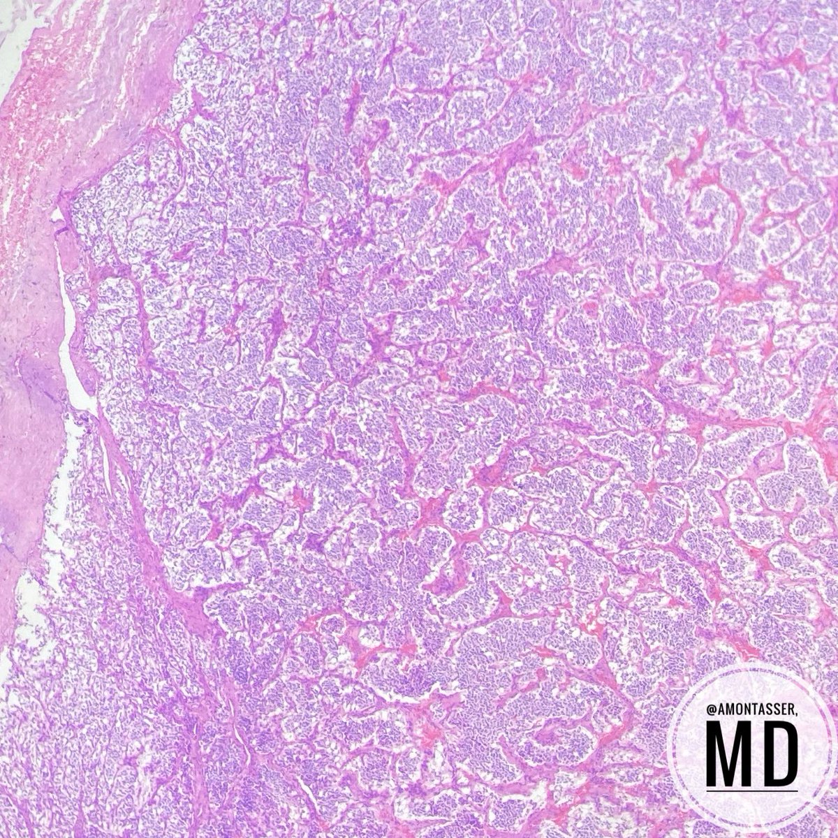 AMontasserMD's tweet photo. When tumors read books:
• At carotid body
• “zellballen” nested arrangement with prominent fibrovascular stroma
• Nuclear atypia but rare mitosis
• Melanin-like pigment 

#Endocrine #Pathology #BenignIsBeautiful #Pathresident #PathClassic https://t.co/kKaX0gZCku
