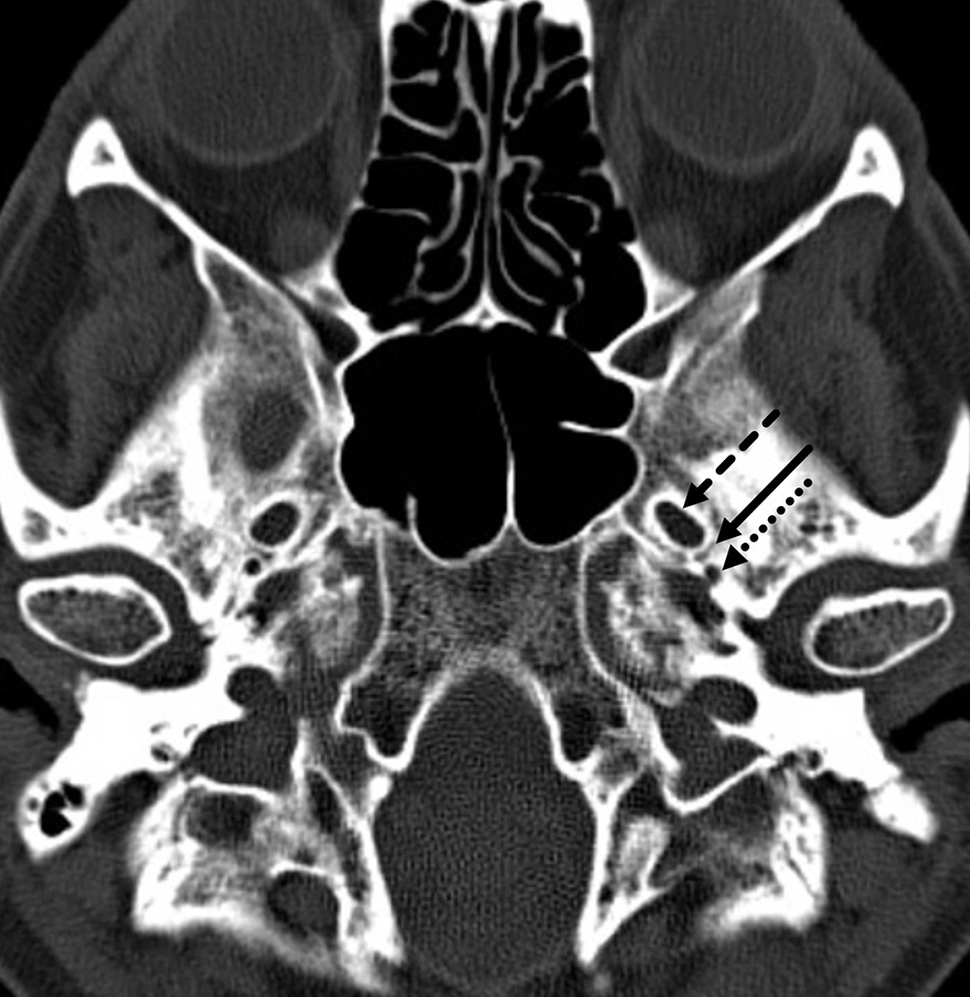 From the December 2021 Issue of #Neurographics: Raiders of the Lost Canal: Review of Underrecognized Skull Base Canals, Fissures, and Foramina ow.ly/NxXV50IggMf