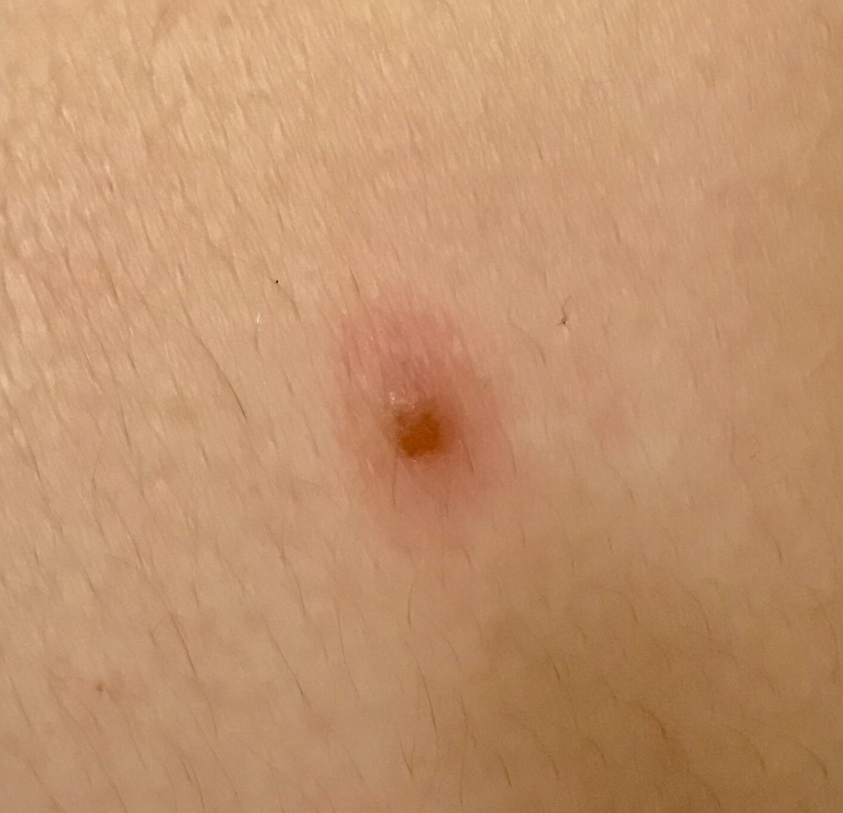 A veces los lunares duelen, molestan y les aparecen un halo rojizo e inflamación. Se denomina foliculitis subnevica.  No es signo de malignidad. <a href="/DermaHUVRocio/">DermaHUVRocio</a>