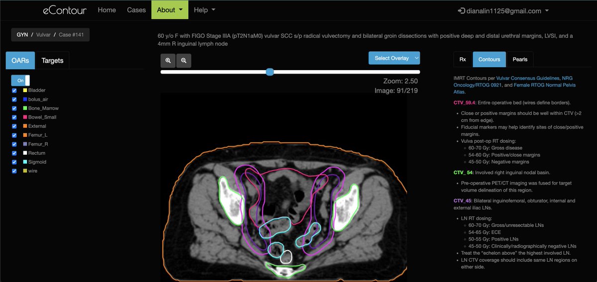 eContour (@econtourradonc) on Twitter photo 🚨 #eContour is proud to announce that cases from 4⃣ of our ⭐️ #ACRO2022 <a href="/ACRORadOnc/">ACRO - American College of Radiation Oncology</a> <a href="/ACROresident/">ACROresident</a> winners are now LIVE❗️
Case 141 - econtour.org/cases/141
Case 142 - econtour.org/cases/142
Case 144 - econtour.org/cases/144
Case 145 - econtour.org/cases/145 🚨 #eContour is proud to announce that cases from 4⃣ of our ⭐️ #ACRO2022 <a href="/ACRORadOnc/">ACRO - American College of Radiation Oncology</a> <a href="/ACROresident/">ACROresident</a> winners are now LIVE❗️
Case 141 - econtour.org/cases/141
Case 142 - econtour.org/cases/142
Case 144 - econtour.org/cases/144
Case 145 - econtour.org/cases/145