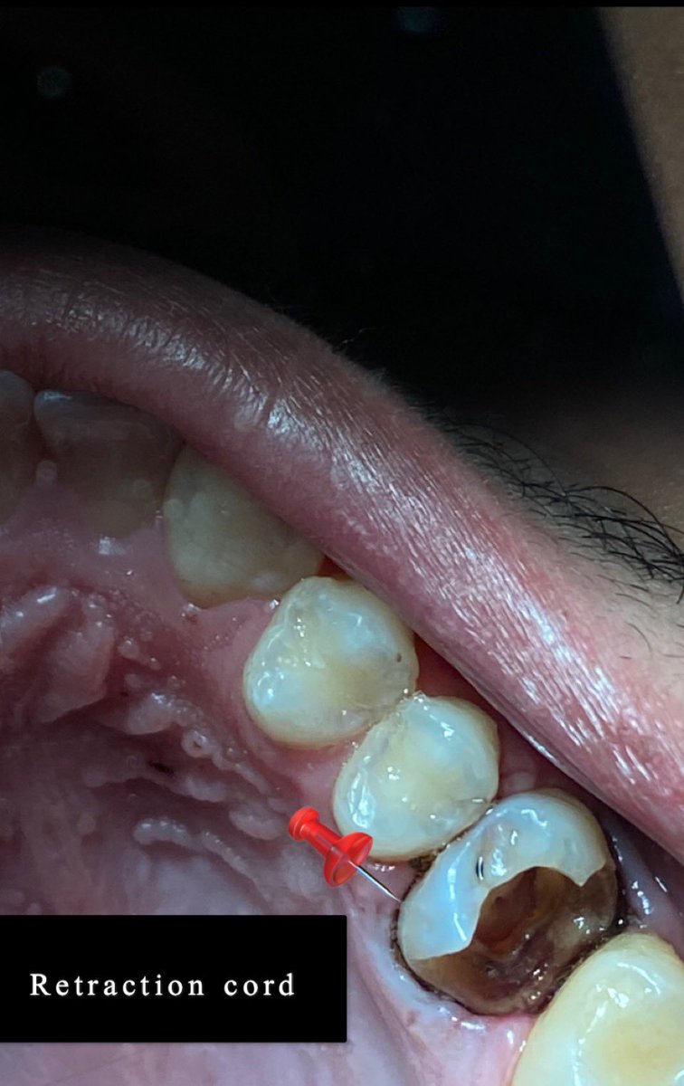 ALDAIL22's tweet photo. ختمنا اليوم قبل الاجازه  بحالة جمعت الاندو والرستو والبريو💉👨‍⚕️ 
Tooth#16 
with pulp polyp and deep margin and 4 -channels and curved mesial Root 
TX/
1-Remove pulp polyp and caries
2-Deep margin elevation🏗 
3-composite buildup
 4- RCT 🕵🏻‍♂️
المريض كان مبسوط مره بالنتيجه🤍
#KKU_dent https://t.co/DM6xQ4ROHm