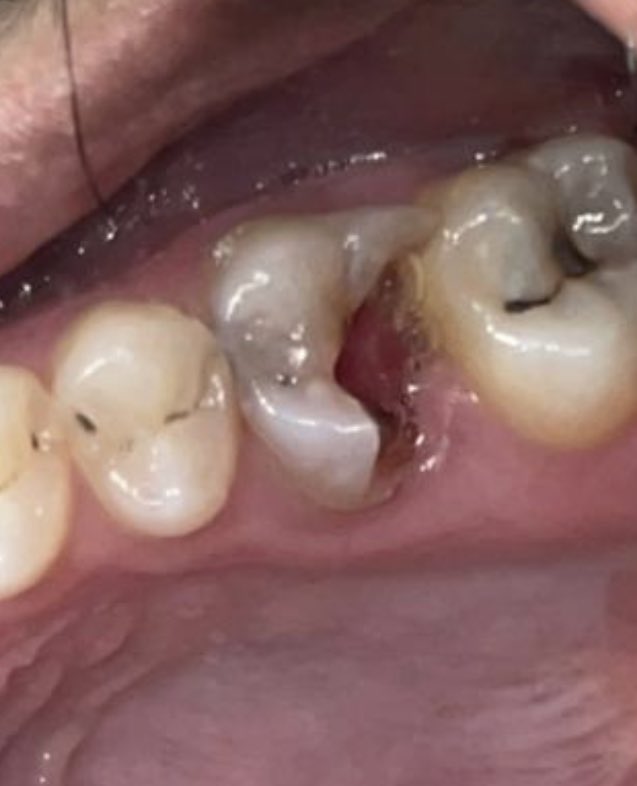 ALDAIL22's tweet photo. ختمنا اليوم قبل الاجازه  بحالة جمعت الاندو والرستو والبريو💉👨‍⚕️ 
Tooth#16 
with pulp polyp and deep margin and 4 -channels and curved mesial Root 
TX/
1-Remove pulp polyp and caries
2-Deep margin elevation🏗 
3-composite buildup
 4- RCT 🕵🏻‍♂️
المريض كان مبسوط مره بالنتيجه🤍
#KKU_dent https://t.co/DM6xQ4ROHm