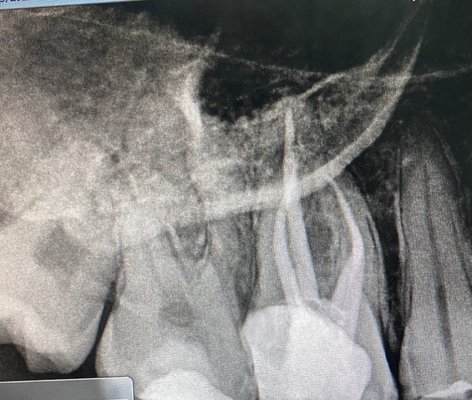 ALDAIL22's tweet photo. ختمنا اليوم قبل الاجازه  بحالة جمعت الاندو والرستو والبريو💉👨‍⚕️ 
Tooth#16 
with pulp polyp and deep margin and 4 -channels and curved mesial Root 
TX/
1-Remove pulp polyp and caries
2-Deep margin elevation🏗 
3-composite buildup
 4- RCT 🕵🏻‍♂️
المريض كان مبسوط مره بالنتيجه🤍
#KKU_dent https://t.co/DM6xQ4ROHm
