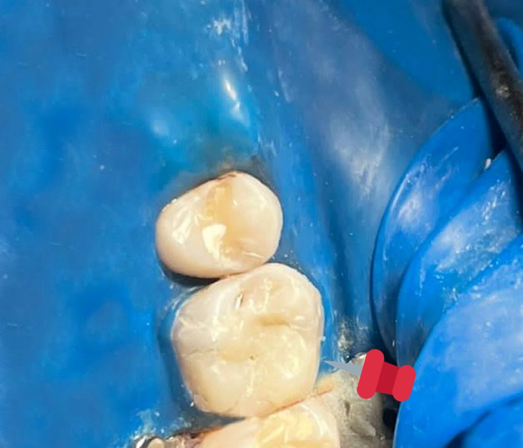 ALDAIL22's tweet photo. ختمنا اليوم قبل الاجازه  بحالة جمعت الاندو والرستو والبريو💉👨‍⚕️ 
Tooth#16 
with pulp polyp and deep margin and 4 -channels and curved mesial Root 
TX/
1-Remove pulp polyp and caries
2-Deep margin elevation🏗 
3-composite buildup
 4- RCT 🕵🏻‍♂️
المريض كان مبسوط مره بالنتيجه🤍
#KKU_dent https://t.co/DM6xQ4ROHm