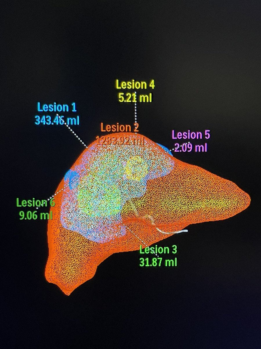 ahmed_kamel_ir's tweet image. It’s now very easy for us to perform image reconstruction, MIPS, 3Ds, and even volumetric measurements without having to leave the Angio room. @UTHouston_IR @memorialhermann #tableside #softwaremanagement #MinimallyInvasiveProcedures
#InterventionalRadiology
#segmentectomy
#Y90