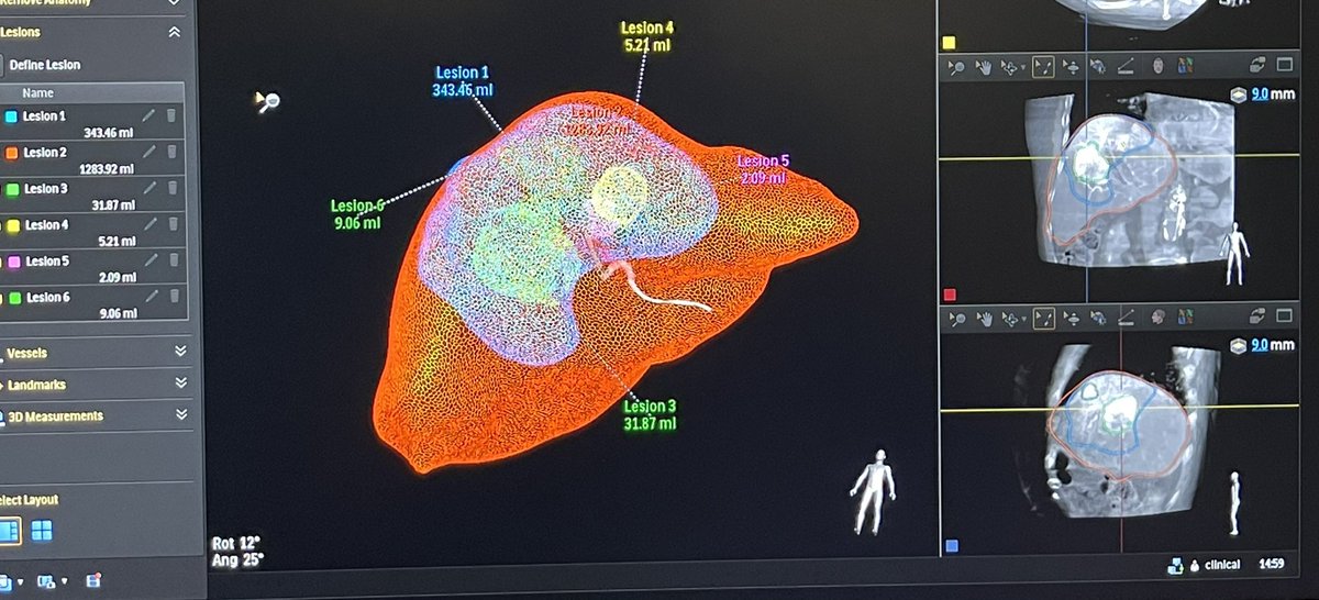 ahmed_kamel_ir's tweet image. It’s now very easy for us to perform image reconstruction, MIPS, 3Ds, and even volumetric measurements without having to leave the Angio room. @UTHouston_IR @memorialhermann #tableside #softwaremanagement #MinimallyInvasiveProcedures
#InterventionalRadiology
#segmentectomy
#Y90