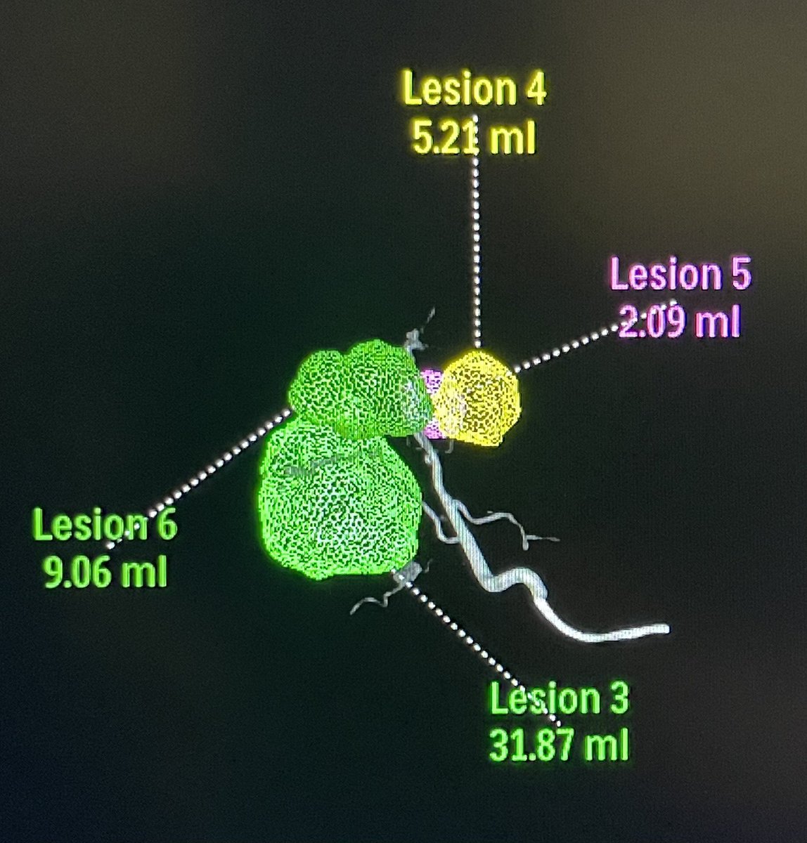 ahmed_kamel_ir's tweet image. It’s now very easy for us to perform image reconstruction, MIPS, 3Ds, and even volumetric measurements without having to leave the Angio room. @UTHouston_IR @memorialhermann #tableside #softwaremanagement #MinimallyInvasiveProcedures
#InterventionalRadiology
#segmentectomy
#Y90
