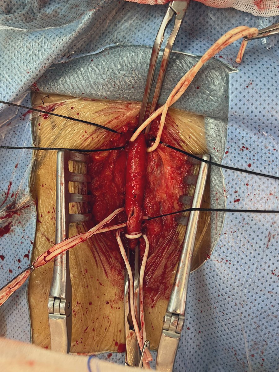 px201407's tweet photo. Endarterectomy of CFA https://t.co/EcBwRdMvcs