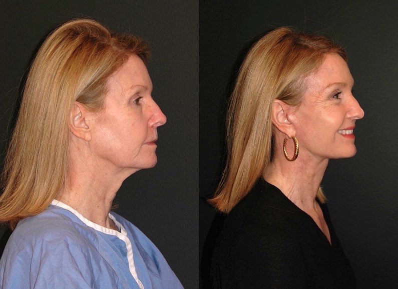 DrJacono's tweet photo. @HuffPost 67 year old patient of mine 3 months after #deepplanefacelift she easily looks 20 yrs younger! The deep plane #facelift lifts dropped mid face, cheeks, jowls &amp;  #nasolabialfold.  Her #necklift and #platysmaplasty gives her such a crisp defined jawline, https://t.co/NHMRCHX85z