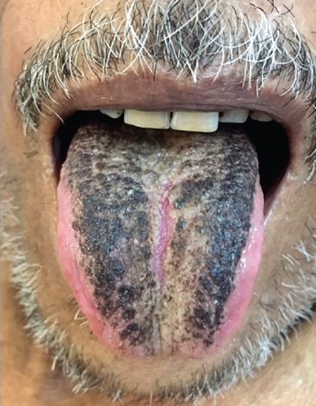 DailyMail's tweet photo. Man's tongue turns BLACK and 'HAIRY' because of his diet https://t.co/xGVN03GCsh https://t.co/z65pSzbVS1