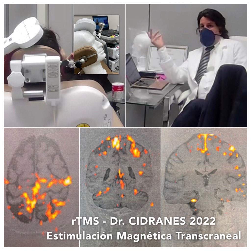 USAnesthesia's tweet photo. Estimulación Magnética Transcraneal 
rTMS- TMS - dTMS -cTMS
La plasticidad neuronal es un fenómeno bien documentado.
Estudiamos  las compensaciones estructurales y neurodinámicas, su utilidad pronóstica y el potencial de crear protocolos efectivos para el TRATAMIENTO DEL DOLOR https://t.co/USw88hf7rr