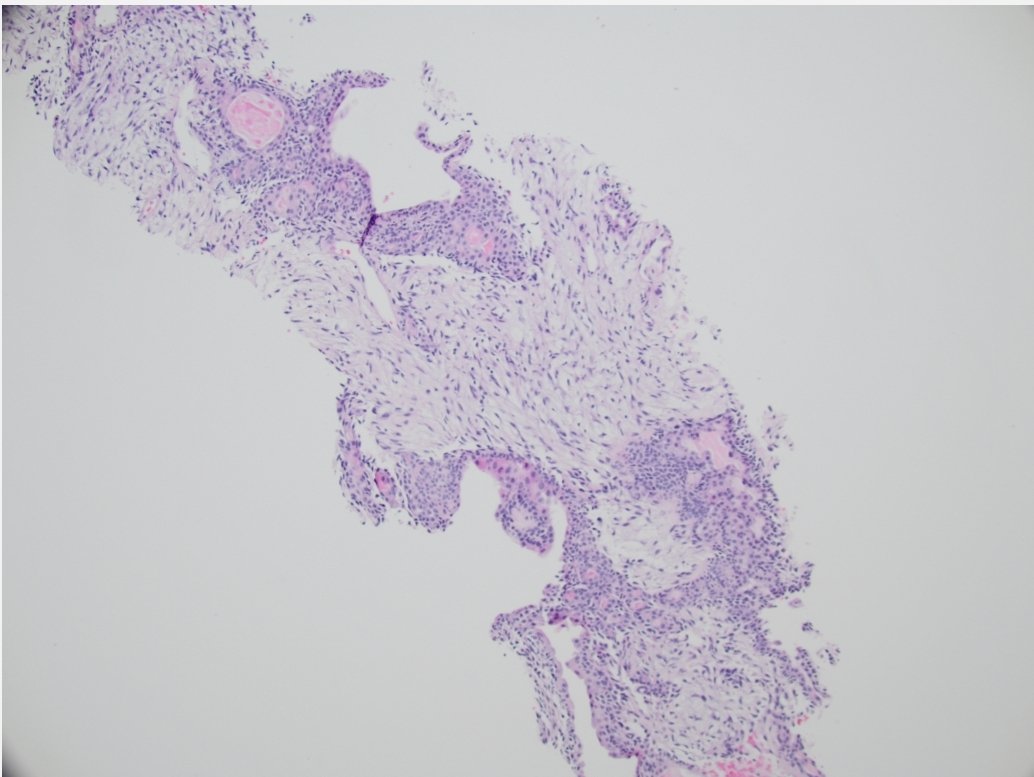 Biopsy of a 17 yo M with a cheek mass. Present for 2 years, asymptomatic, and felt on palpation. Any thoughts? 🙃
  #pedipath #dermpath #BSTPath