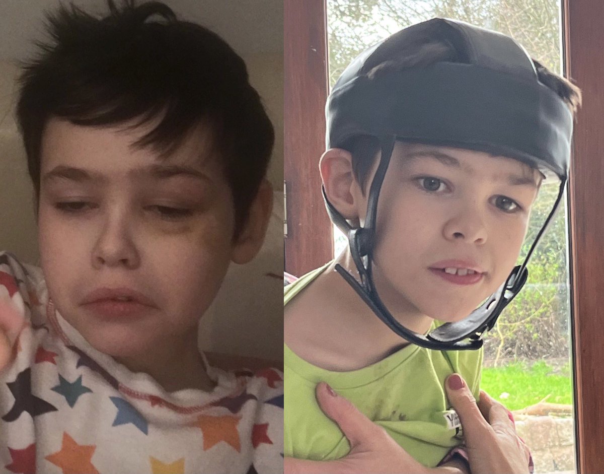 Is it ethical to allow children like Ben to run out of cannabis oil medication keeping them well, to go back to the picture on the left where he had no quality of life?

#cruellydeniedNHSaccess 
#EndOurPain
#cannabisismedicine
#epilepsy