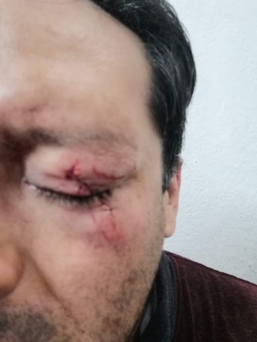 ToroBolito1971's tweet photo. David Bárcenas casi perdió su ojo mientras trabajaba como asistente de cámaras de Ecuador TV su reconocimiento fue el ser despedido del canal por Carla Maldonado https://t.co/ANIeVMBkhj