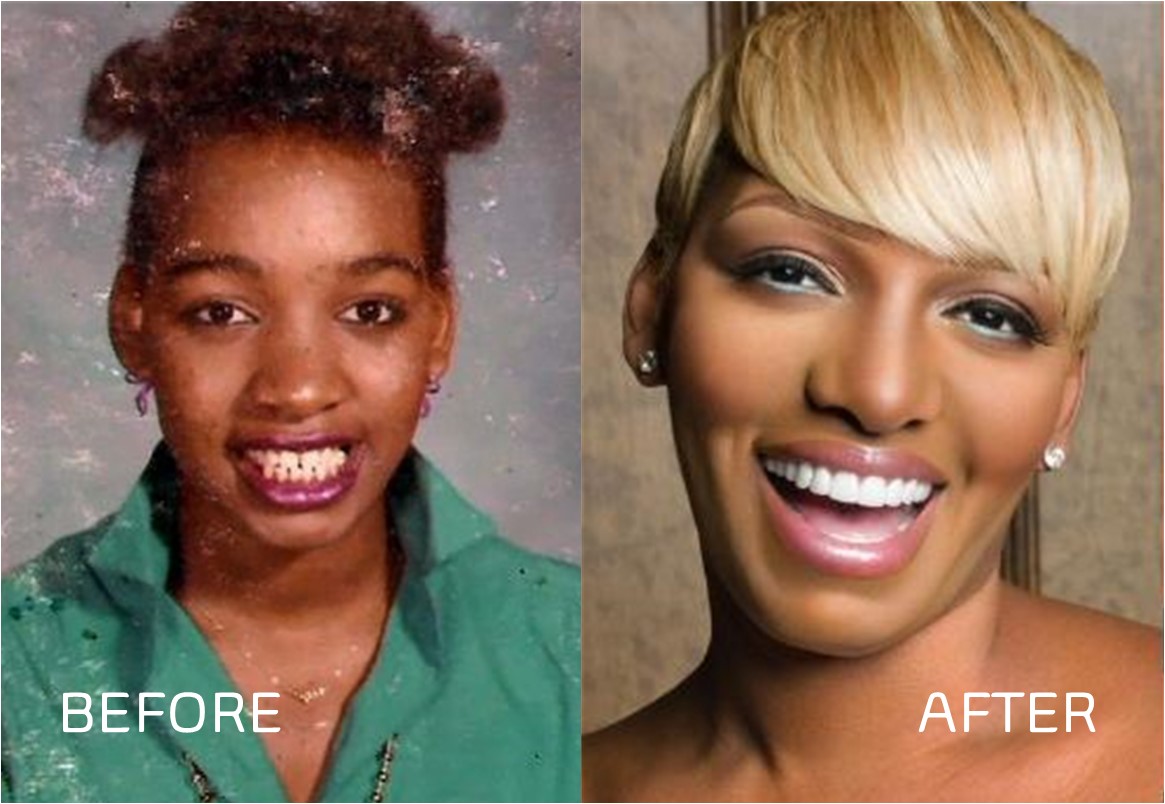 Nene Leakes teeth: before and after dental service