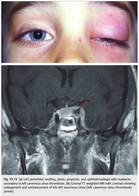 OBandarchi's tweet photo. Left #CavernousSinus #Thrombosis https://t.co/FFTw9Tm8hp