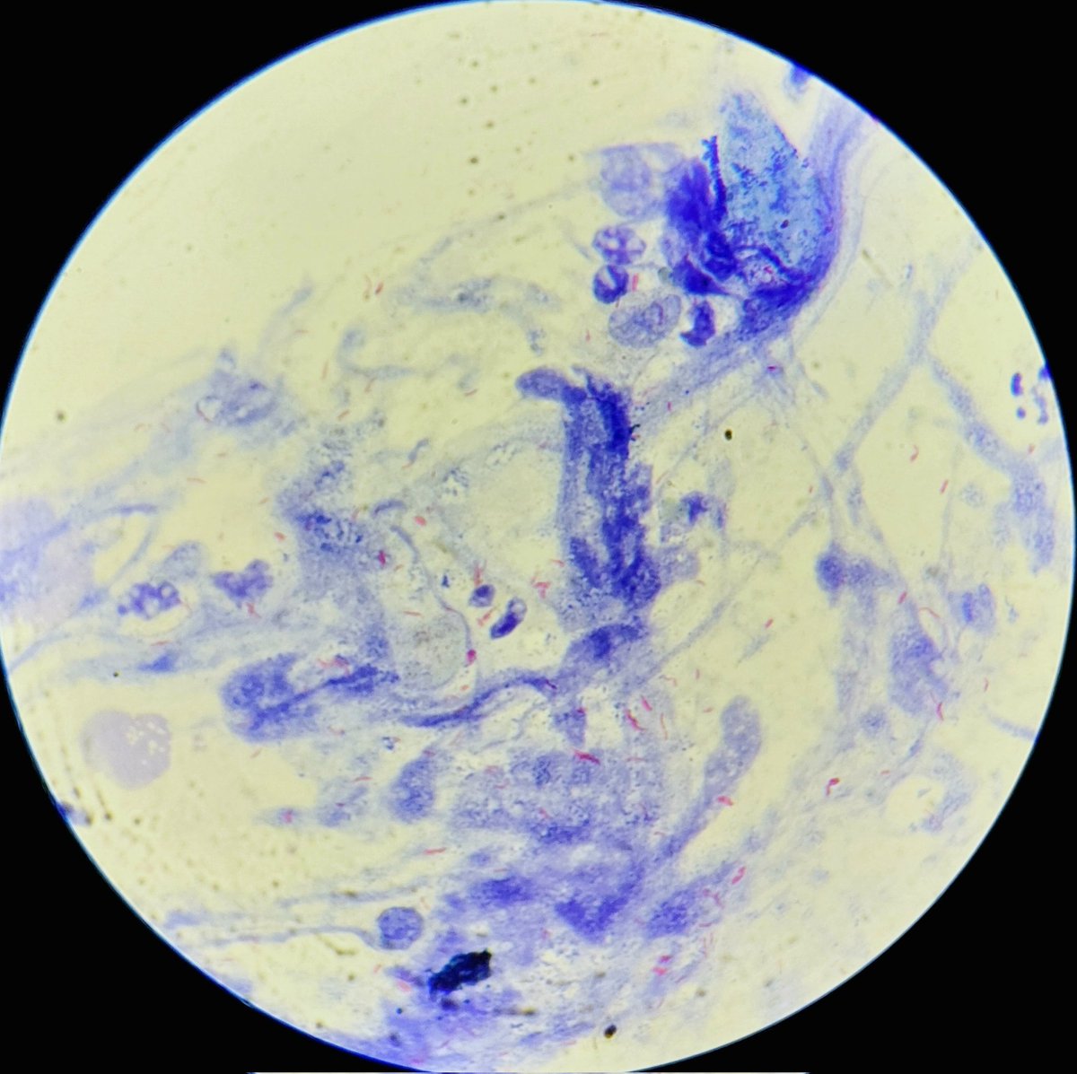 padmapathology1's tweet photo. Studded with pink beads📿
#idpath #PathTwitter #microbiology #acidfast
#infectiousdiseases https://t.co/Z2ahUSwp3B