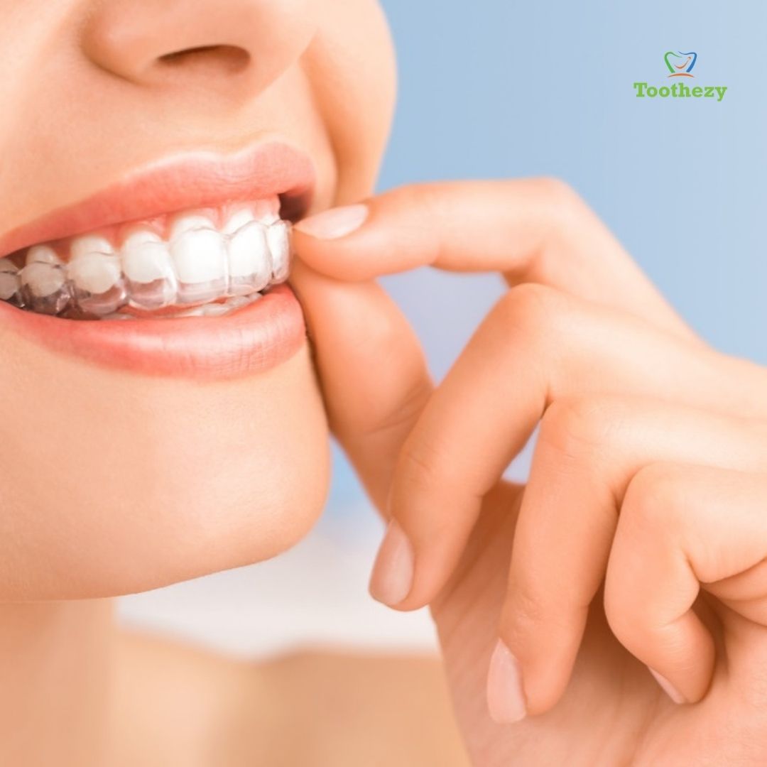 Toothezy's tweet image. Without a smilling pace, the face is simply negligible. A grin is a justification for why our face looks so delightful. Around here at Toothezy, we work with our group to protect the grin on the essences of our clients.
Visit to our website: toothezy.com
#teethaligner