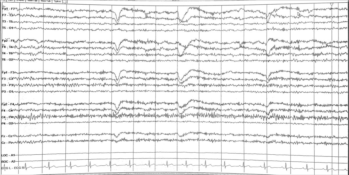 Fbabtain's tweet photo. A routine #EEG in a young man with #epilepsy, on clobazam.
Apart from the excess beta, look carefully at what we first comment on in any EEG report?
⛔️ Can you see what I see?
#Twittermed
#TwitterMD
#MedicalEducation
#EEGTutorial
@EEGTalk https://t.co/BwkaDt53Fq