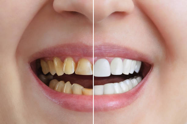 What’s the Difference between General and Cosmetic Dentistry? General #dentistry focuses on preventing and treating oral disease while #cosmetic dentistry deals with the overall aesthetic appearance of teeth 🦷

#dentalcare #cosmeticdentist 

Detail post: fitzgeralddentistry.com/blog/differenc…
