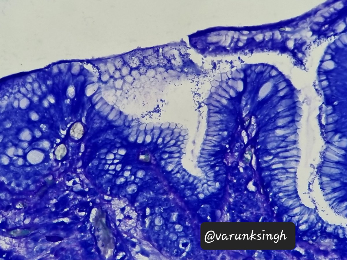 varunksingh's tweet photo. Found it today! Coccoid forms of H.pylori. Patient treated previously for the same came back with active gastritis. Thankfully there were curvilinear forms too🙏 #GIpath #pathology #PathTwittter https://t.co/puBm2TtBOH
