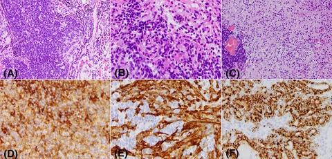 brainpathol's tweet photo. INVITED REVIEW: CNS embryonal and mesenchymal non-meningothelial tumors, comprising the most current available information with clinical implications
by David Meredith and Sanda Alexandrescu @BWHPath @BostonChildrens #neuropath #pedipath #bstpath
https://t.co/Tj7IvEYHwR https://t.co/zdLmk7FpaY