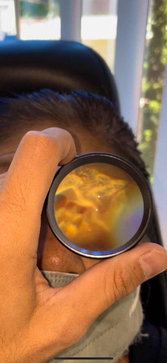 Desprendimiento de retina.