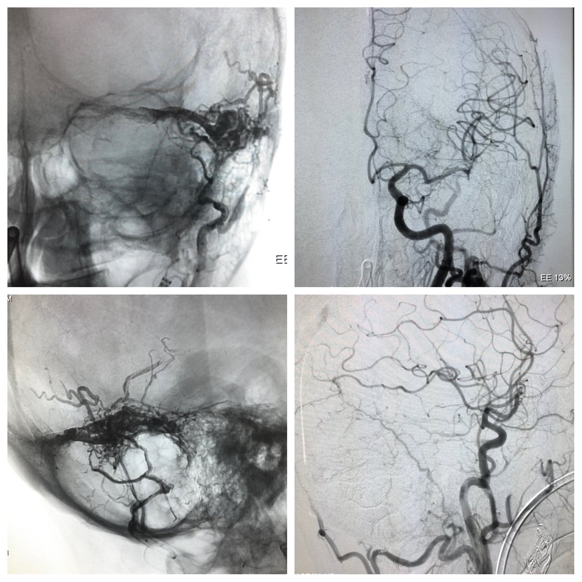 A dural arteriovenous fistula treated by double arterial embolization. pubmed.ncbi.nlm.nih.gov/33004343/