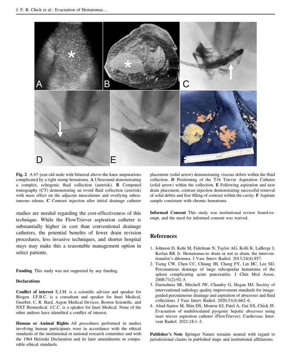 Jeffrey F. B. Chick, MD, MPH (@chickvir) on Twitter photo Large-bore aspirations using the <a href="/InariMedical/">Inari, now part of Stryker</a> FlowTriever may serve as a reasonable treatment option for hematoma drainages. More to come. <a href="/davidsshin/">David Shin</a> <a href="/Eric_Monroe_MD/">Eric Monroe, MD</a> <a href="/mabadsantos/">Matt Abad-Santos</a> <a href="/UofWa_IR/">University of Washington IR Residency</a> <a href="/JVIRmedia/">JVIR</a> <a href="/CVIR_Journal/">CVIR Journal</a> Large-bore aspirations using the <a href="/InariMedical/">Inari, now part of Stryker</a> FlowTriever may serve as a reasonable treatment option for hematoma drainages. More to come. <a href="/davidsshin/">David Shin</a> <a href="/Eric_Monroe_MD/">Eric Monroe, MD</a> <a href="/mabadsantos/">Matt Abad-Santos</a> <a href="/UofWa_IR/">University of Washington IR Residency</a> <a href="/JVIRmedia/">JVIR</a> <a href="/CVIR_Journal/">CVIR Journal</a>