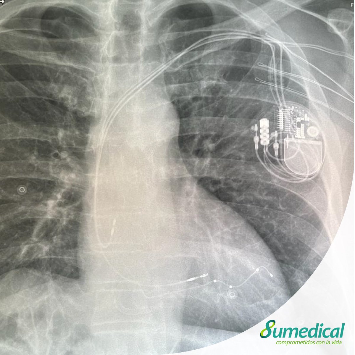 SumedicalS's tweet photo. Imagen real de un CRTP con técnica "HOT CRT".
Este es un resincronizador cardiaco que se implanta en pacientes con insuficiencia cardiaca, en el cual se coloca un cable en cada ventriculo para lograr que ellos se contraigan al mismo tiempo, como naturalmente debería de suceder. https://t.co/JICYtlHypV