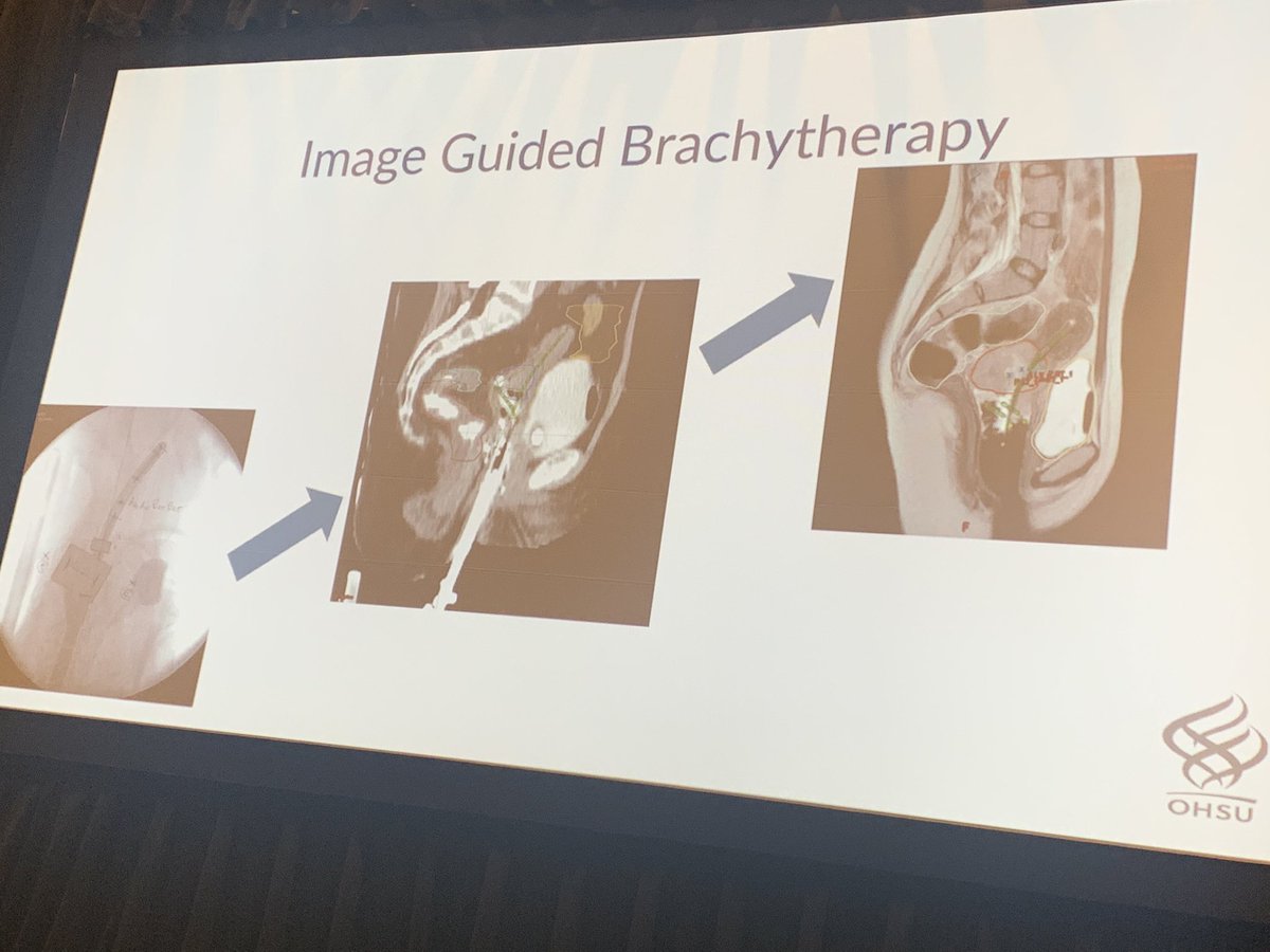 IvyRadOncMD's tweet photo. Addressing the role of #brachy &amp; hybrid applicators by @jennamkahn #ACRO22 to increase dose to tumor &amp; decrease dose to organs at risk to improve #CervicalCancer outcomes. @ACRORadOnc @ACROresident #ThisIsBrachy https://t.co/s5cXt4jVZg