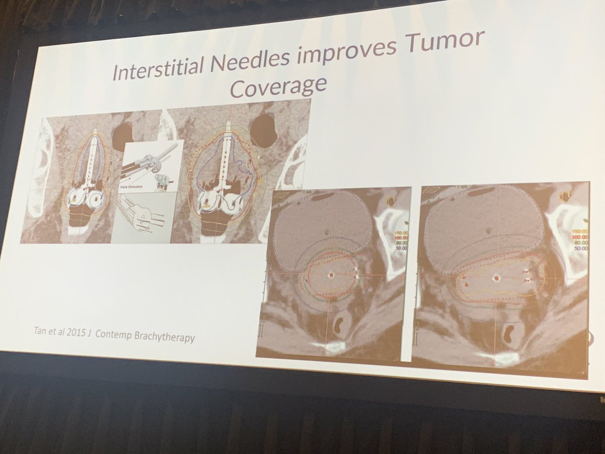 IvyRadOncMD's tweet photo. Addressing the role of #brachy &amp; hybrid applicators by @jennamkahn #ACRO22 to increase dose to tumor &amp; decrease dose to organs at risk to improve #CervicalCancer outcomes. @ACRORadOnc @ACROresident #ThisIsBrachy https://t.co/s5cXt4jVZg