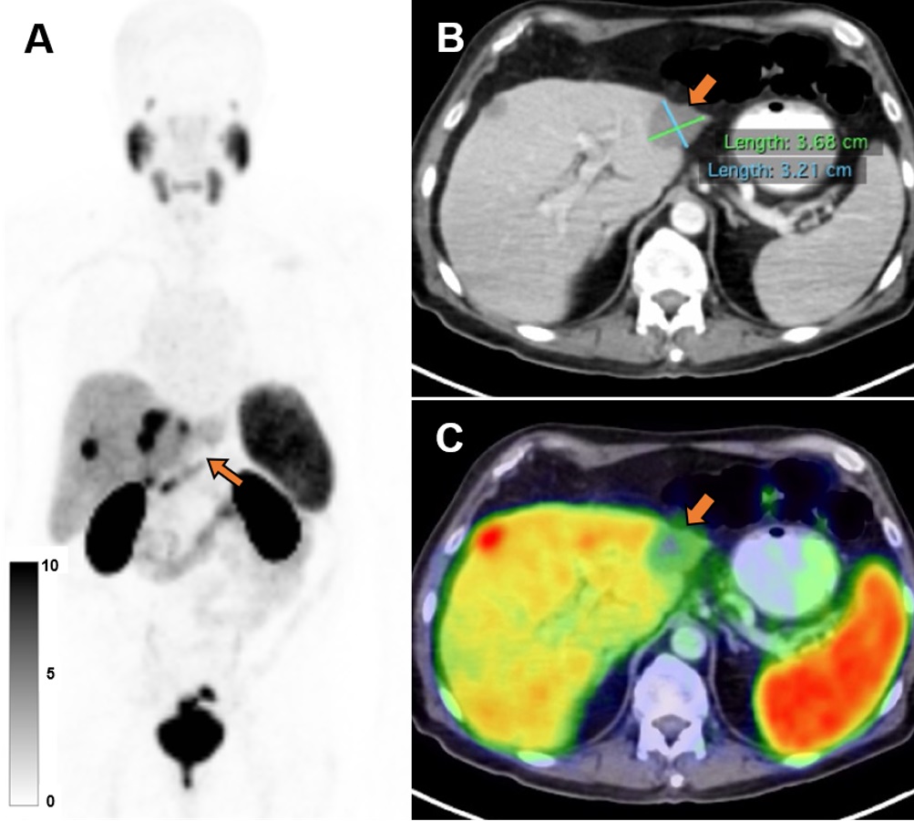 Pre-therapy PSMA PET/CT is a biomarker of target expression that helps to predict patient response to 177Lu-PSMA therapy. ow.ly/TNC850Ih2Vn

#PrecisionMedicine #PETCT #ProstateCancer <a href="/masatoshihotta/">Masatoshi Hotta</a> <a href="/CalaisJeremie/">Jeremie Calais</a>