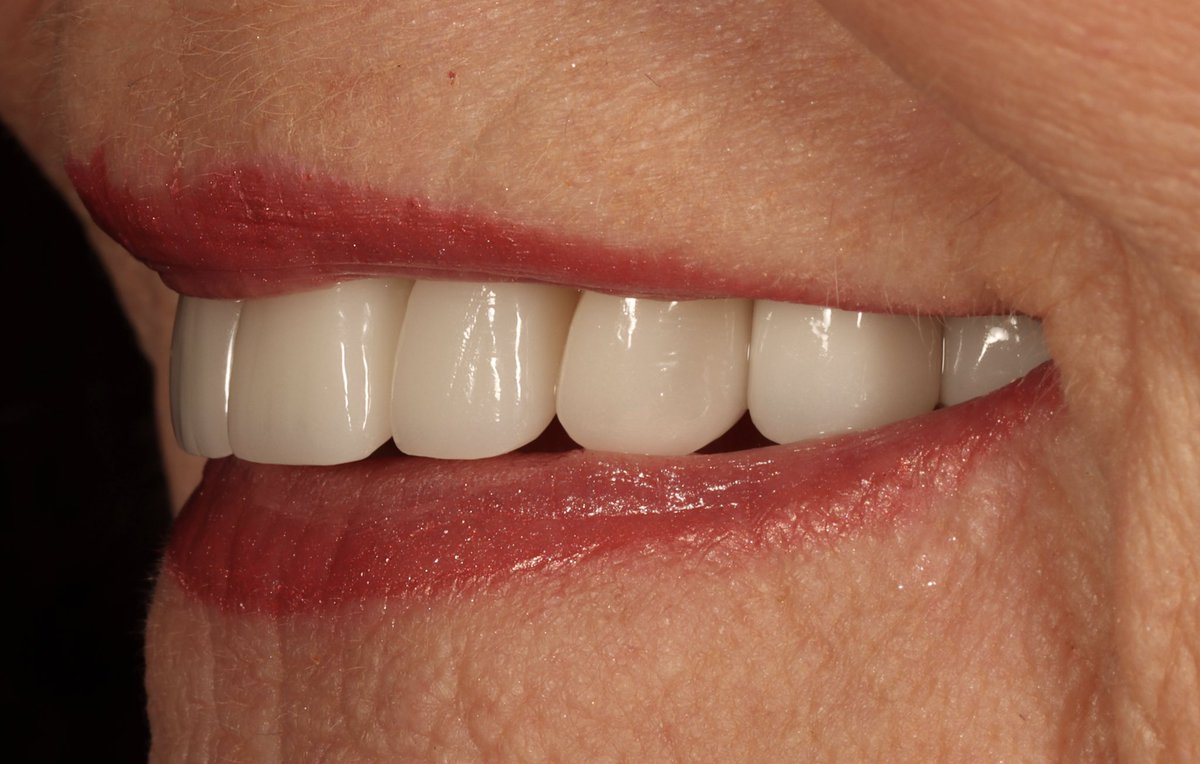 AmarilloSmiles's tweet photo. 6 root canals, 2 implants, 20 core build-ups, and 28 units of beautiful IPS e.max later, we officially completed this smile restoration this week! #cosmetics #function #neuromusculardentistry #bitemanagement #smilemakeover https://t.co/np7qU7j1Az