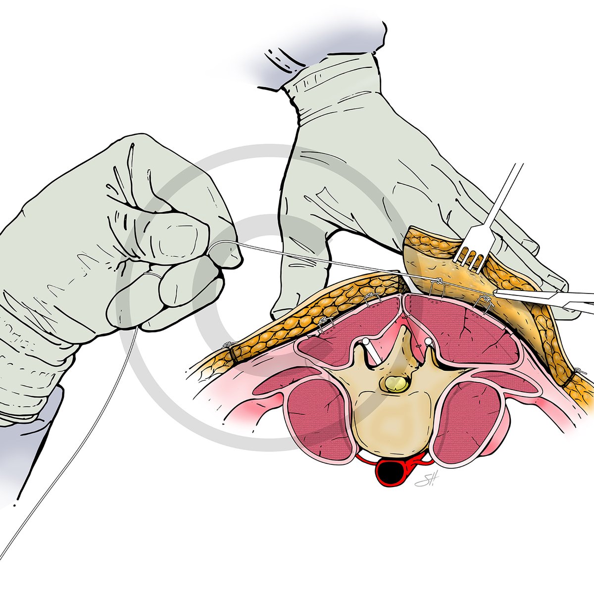 Scott Holmes, CMI (@scottholmescmi) on Twitter photo Book chapter figures and patient guide imagery in the works this week for <a href="/BCM_Surgery/">BCM_Surgery</a> <a href="/DrRosengart/">Todd Rosengart, MD</a> <a href="/WinocourMD/">Sebastian Winocour, MD, MBA, FACS</a> Book chapter figures and patient guide imagery in the works this week for <a href="/BCM_Surgery/">BCM_Surgery</a> <a href="/DrRosengart/">Todd Rosengart, MD</a> <a href="/WinocourMD/">Sebastian Winocour, MD, MBA, FACS</a>