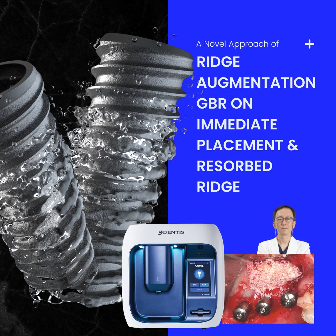 GDIAcademy's tweet photo. Join us for this course:
https://t.co/KNogT7PsZZ

#GDIA #GlobalDentalImplantAcademy #Immediateplacement #SQUVA #Ridgeaugmentation #Dentistry #Dentalimplants https://t.co/ItuEvzh77c