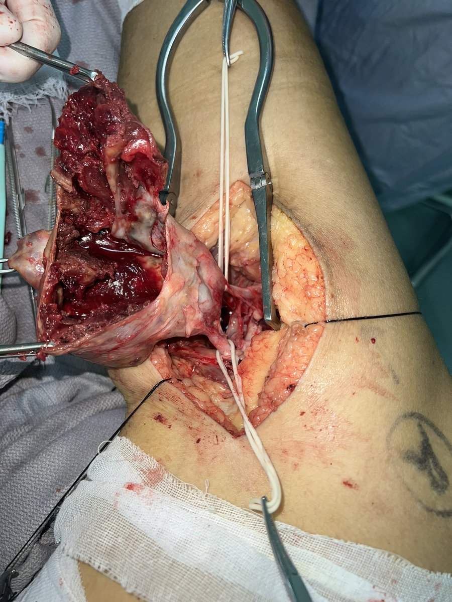 px201407's tweet photo. Huge popliteal aneurysm! https://t.co/dKBZ5kg0lZ