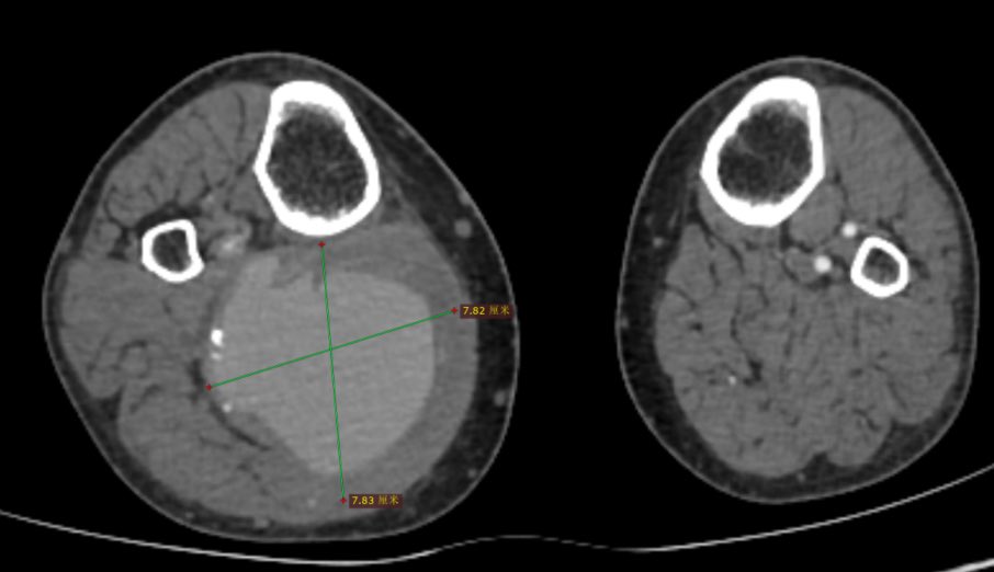 px201407's tweet photo. Huge popliteal aneurysm! https://t.co/dKBZ5kg0lZ