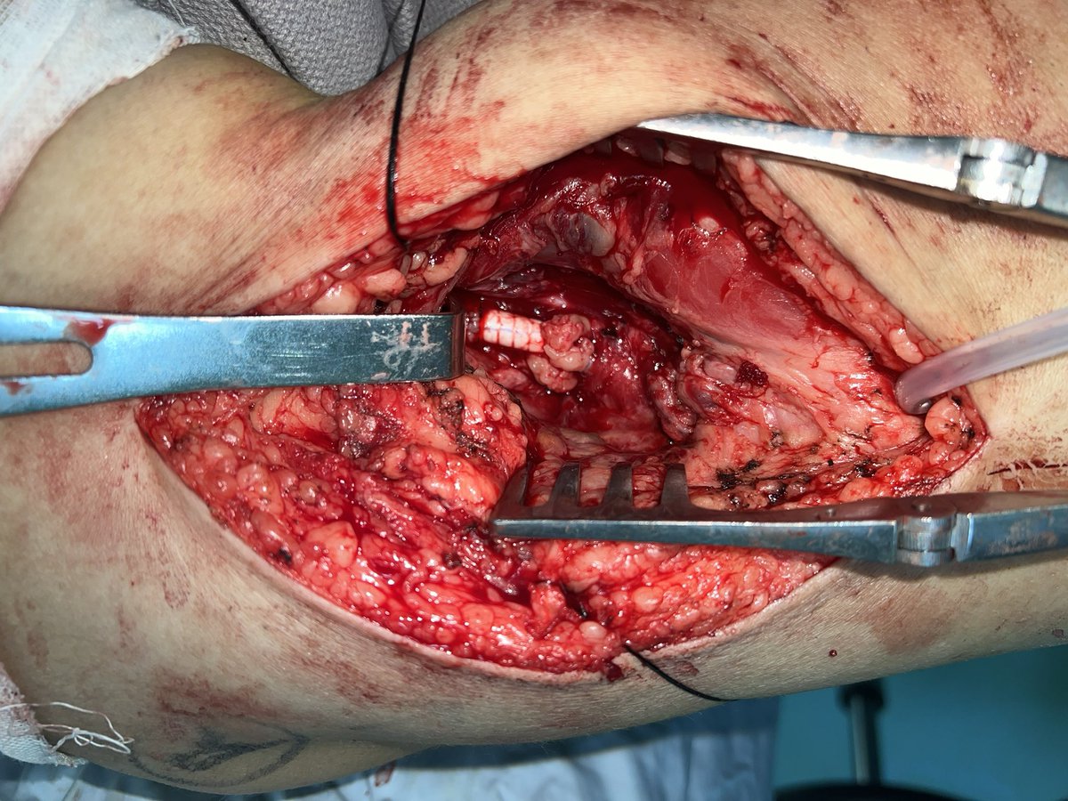 px201407's tweet photo. Huge popliteal aneurysm! https://t.co/dKBZ5kg0lZ