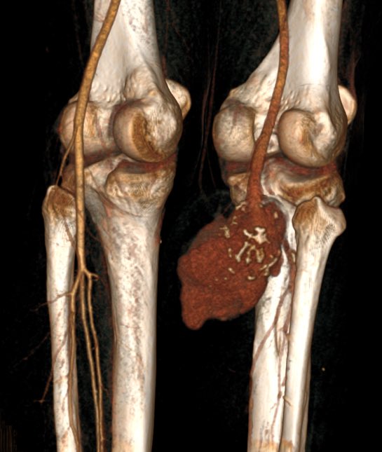 px201407's tweet photo. Huge popliteal aneurysm! https://t.co/dKBZ5kg0lZ