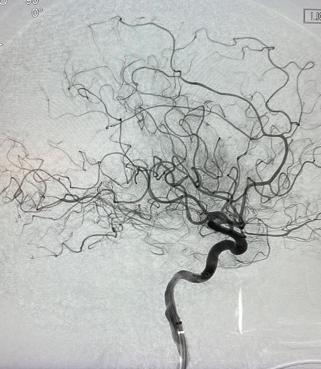 Acute left proximal M2 occlusion with bovine arch. Transradial access using the Balt Ballast 100cm sheath without struggle. The extra length helped with left distal ICA access. Successfully recanalized after single pass. #RadialFirst #EVT