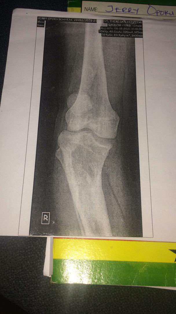 JJCubes's tweet photo. Hello Twitter family. 
There is a free bone surgery currently ongoing in Nandom, St. Theresa’s Hosp. If you know anyone suffering from bone deformity or is in need of a bone related surgery &amp; can’t afford it; this is the best gift to give them. Share n Save Lives 
Before &amp; After https://t.co/JA0a6UtidP