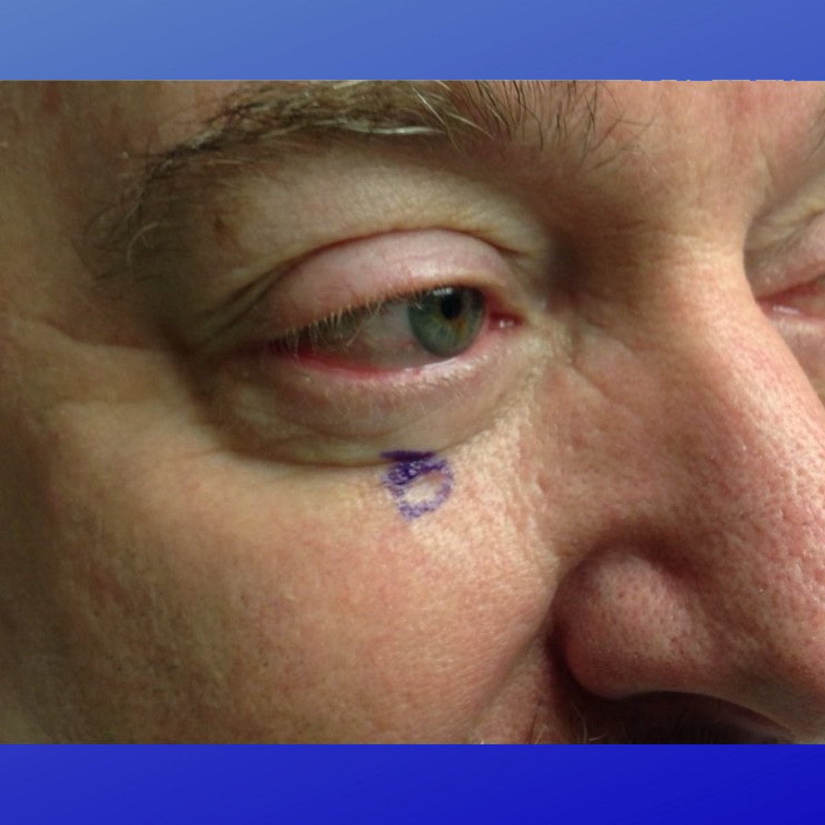 MohsCollege's tweet photo. #FlapFriday- This patient underwent Mohs surgery for a Basal cell carcinoma on the right infraorbital rim. Defects in the mid/upper cheek require attention to detail, as there are few ways to conceal the scar... https://t.co/iszCqMxruF