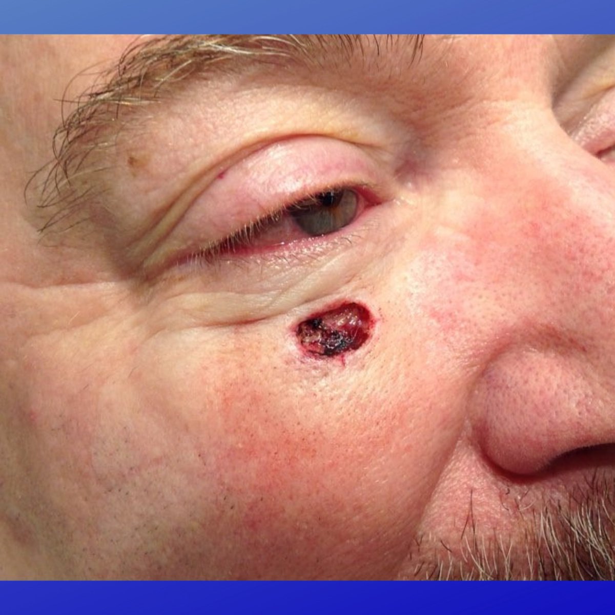 MohsCollege's tweet photo. #FlapFriday- This patient underwent Mohs surgery for a Basal cell carcinoma on the right infraorbital rim. Defects in the mid/upper cheek require attention to detail, as there are few ways to conceal the scar... https://t.co/iszCqMxruF